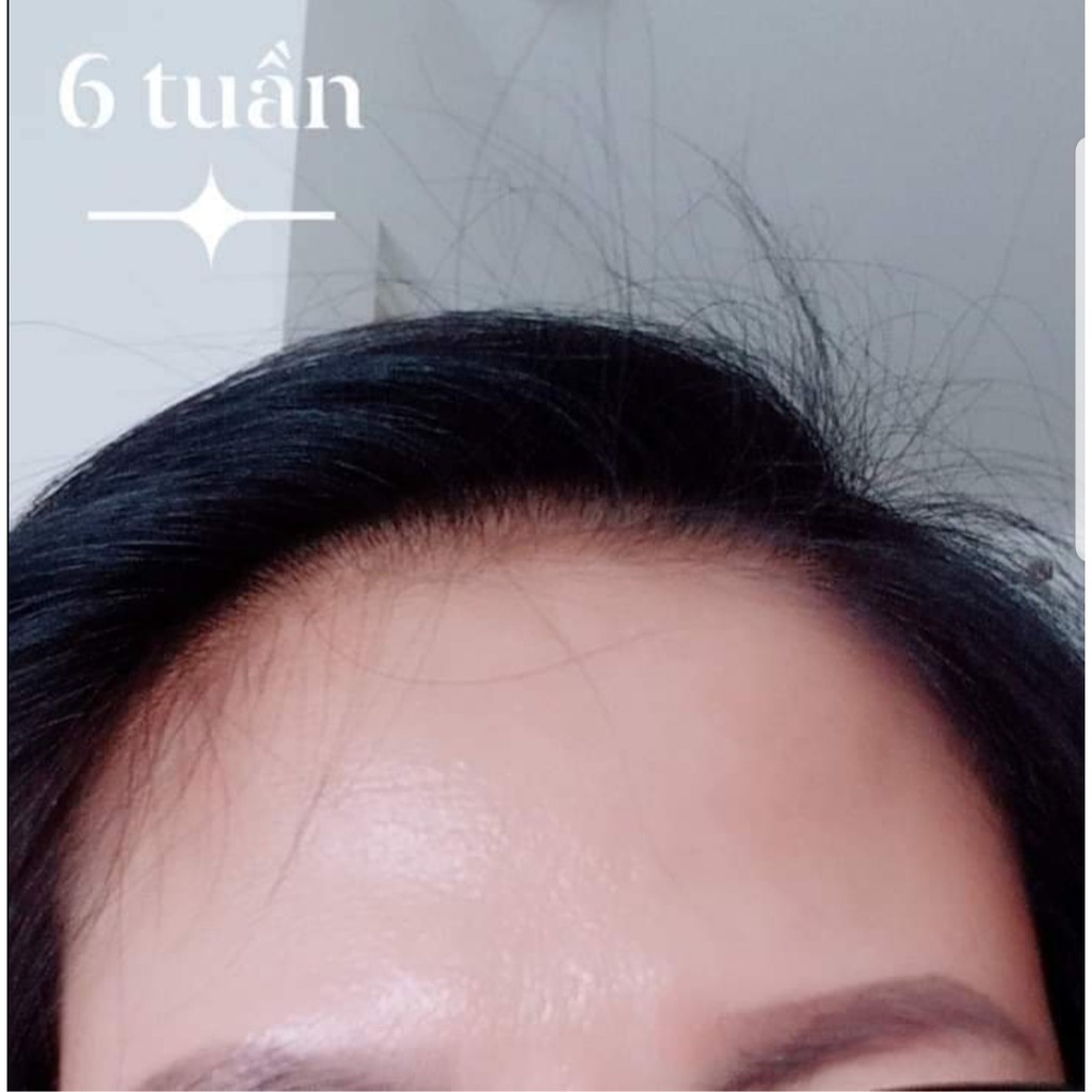 Gội xả Trái nhàu NoNi Anjo