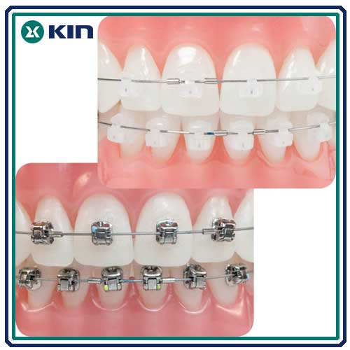 Điều Trị Chỉnh Nha – Đưa Răng Vào Thẳng Hàng