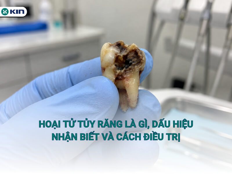Hoại tử tủy răng là gì, dấu hiệu nhận biết và cách điều trị