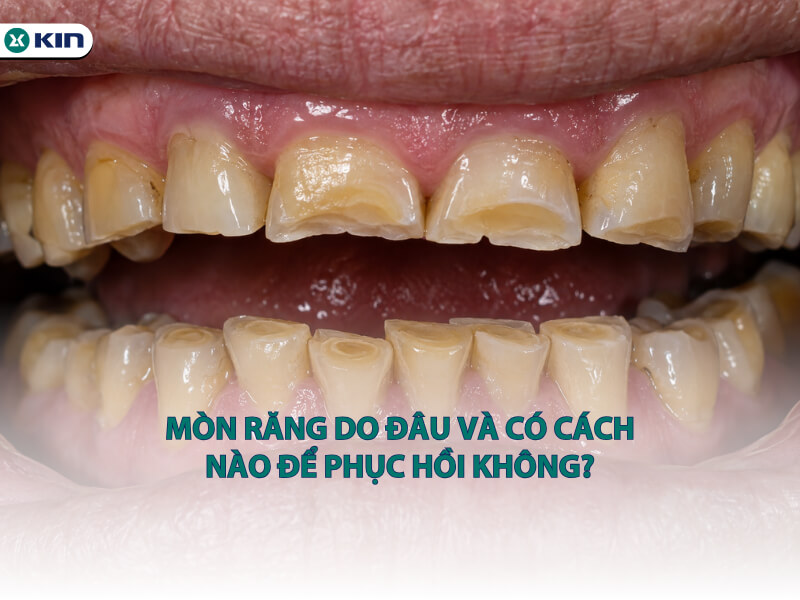 Mòn răng do đâu và có cách nào để phục hồi không?