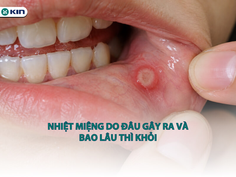 Nhiệt miệng do đâu gây ra và bao lâu thì khỏi