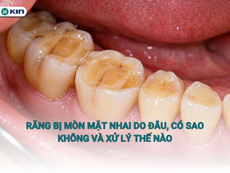 Răng bị mòn mặt nhai do đâu, có sao không và xử lý thế nào