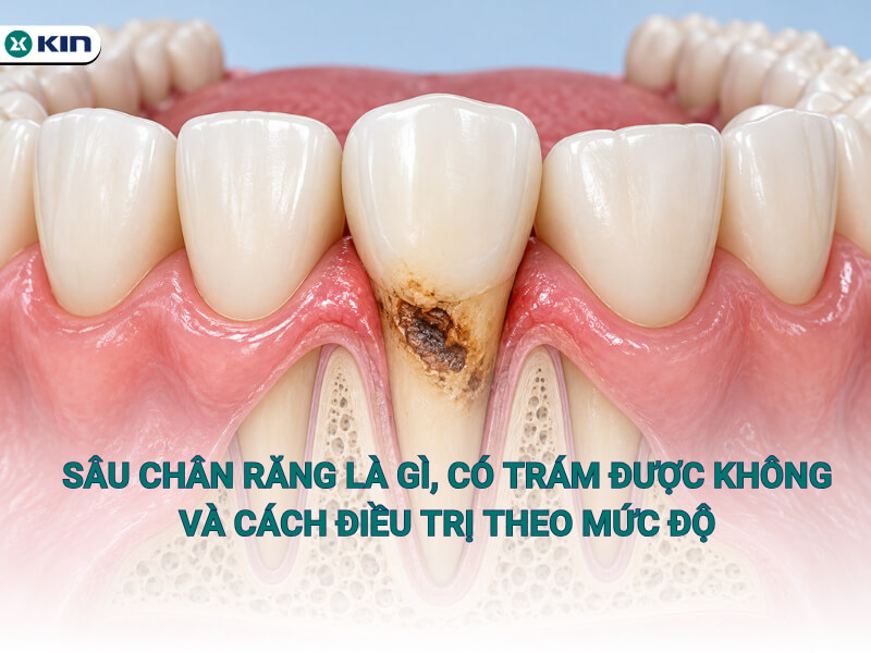 Sâu chân răng là gì, có trám được không và cách điều trị theo mức độ