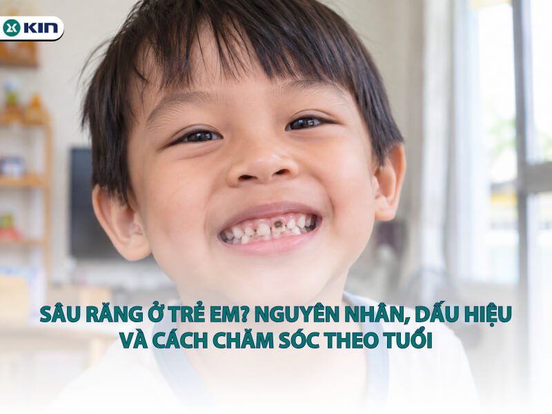 Sâu răng ở trẻ em? Nguyên nhân, dấu hiệu và cách chăm sóc theo tuổi