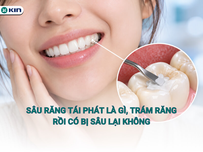 Sâu răng tái phát là gì, trám răng rồi có bị sâu lại không