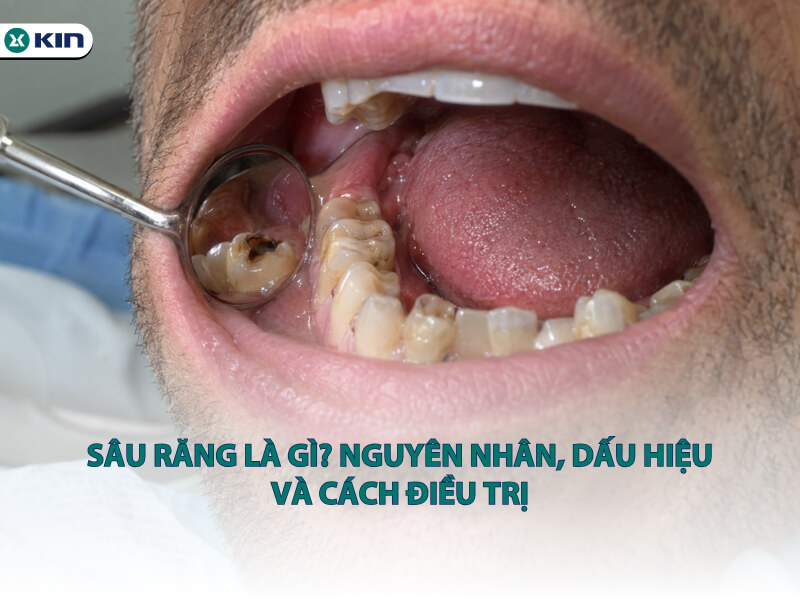Sâu răng là gì? Nguyên nhân, dấu hiệu và cách điều trị