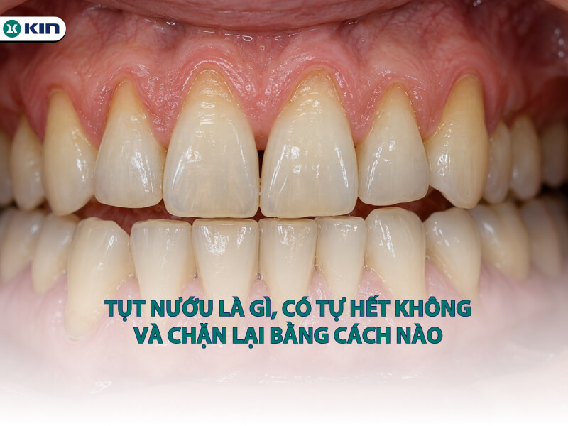 Tụt nướu là gì, có tự hết không và chặn lại bằng cách nào