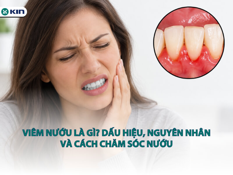 Viêm nướu là gì? Dấu hiệu, nguyên nhân và cách chăm sóc nướu