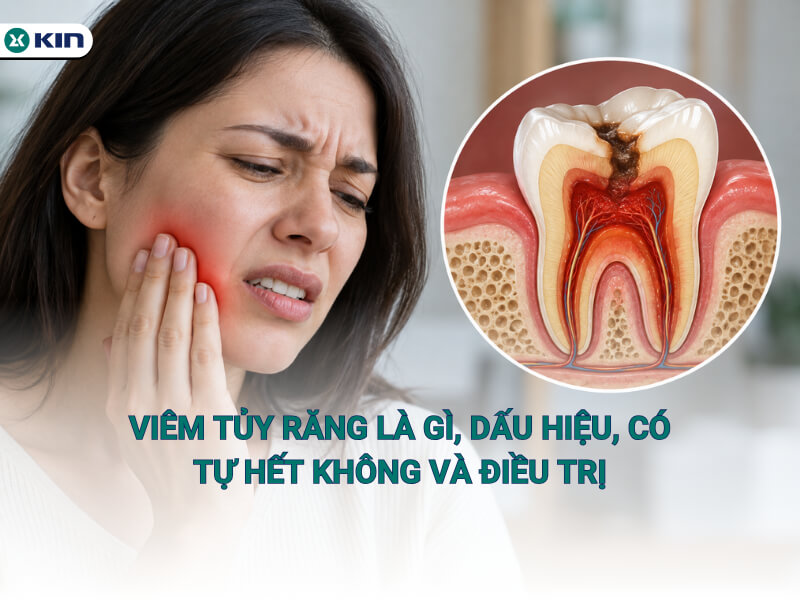 Viêm tủy răng là gì, dấu hiệu, có tự hết không và điều trị