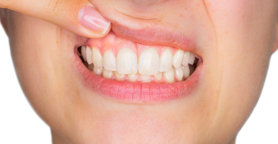 Viêm lợi là gì? Cách điều trị viêm lợi