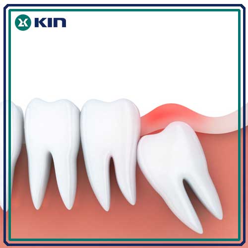 Những điều bạn cần biết về răng khôn