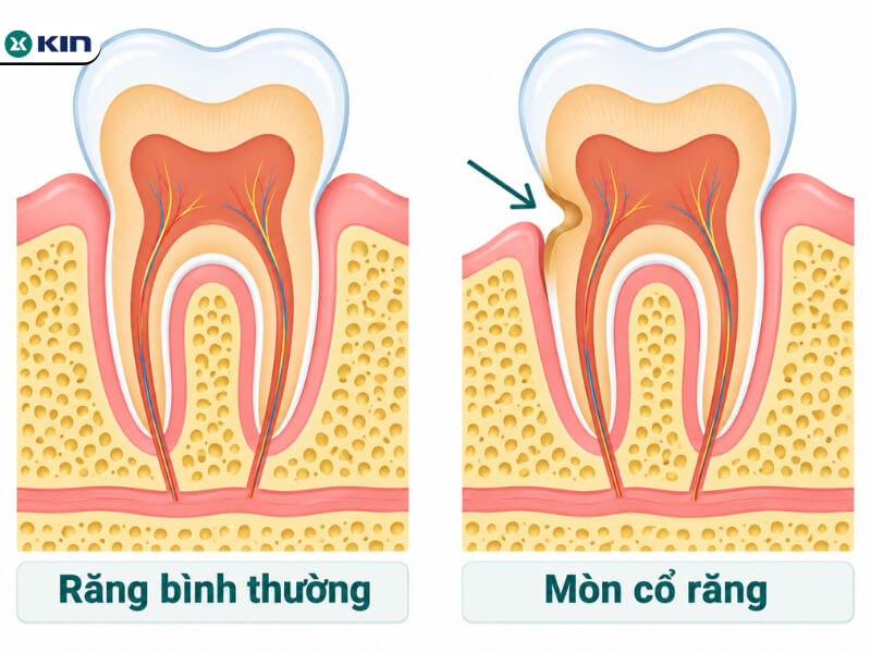 Phân biệt tình trạng răng bình thường và răng bị mòn ở cổ