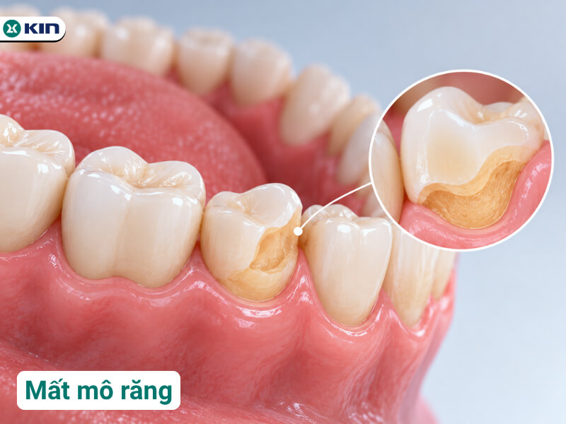 Mất mô răng