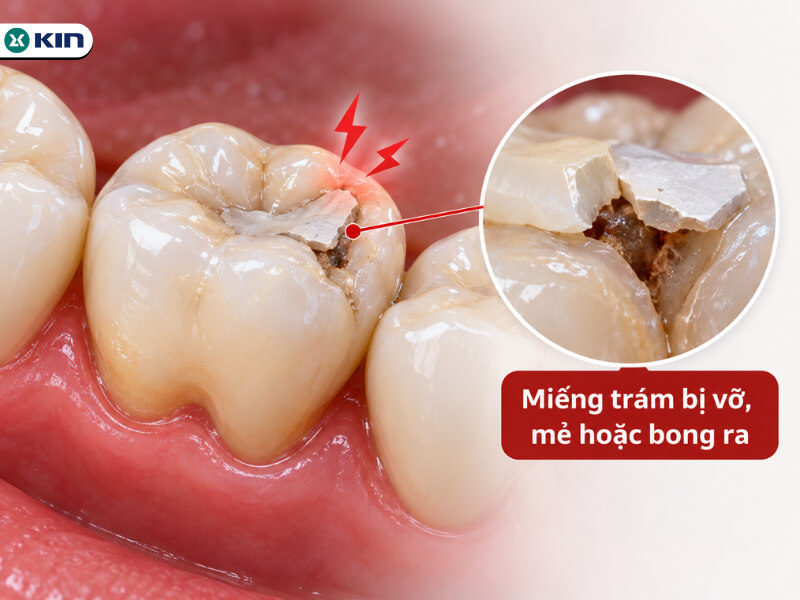 Miếng trám bị vỡ, mẻ hoặc bong ra
