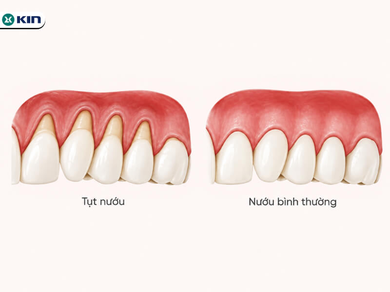 So sánh tình trạng tụt nướu và nướu bình thường