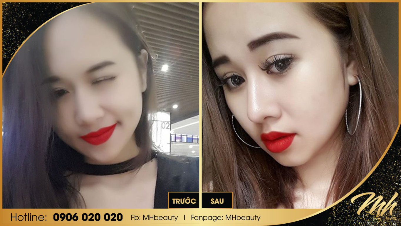 Hình ảnh thay đổi của khách hàng trước và sau khi phẫu ...