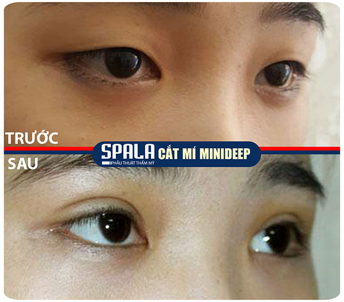 Sức khỏe, đời sống: Cắt mắt 2 mí thẩm mỹ viện Spala ? Cat-mi-minideep-03-seo