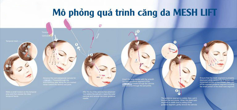 Căng Da Mặt Mesh Lift tại Spala
