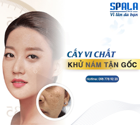 Spala Clinic khử nám tận gốc bằng phương pháp cấy vi chất tái sinh