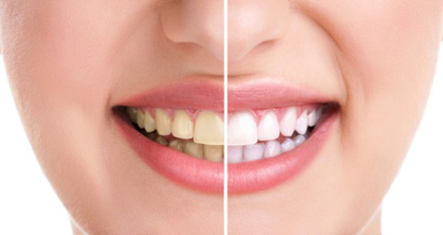 6 Phương pháp hiệu quả chữa hàm răng ố vàng