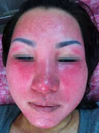 Cảnh báo với biến chứng khi điều trị da tại spa Cảnh báo với biến chứng khi điều trị da tại spa