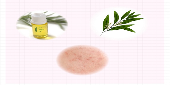 Công dụng không ngờ của tinh dầu tràm trong cuộc sống