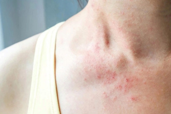 Da sẽ bị kích ứng nếu đeo dây chuyền kém chất lượng liên tục trong thời gian dài