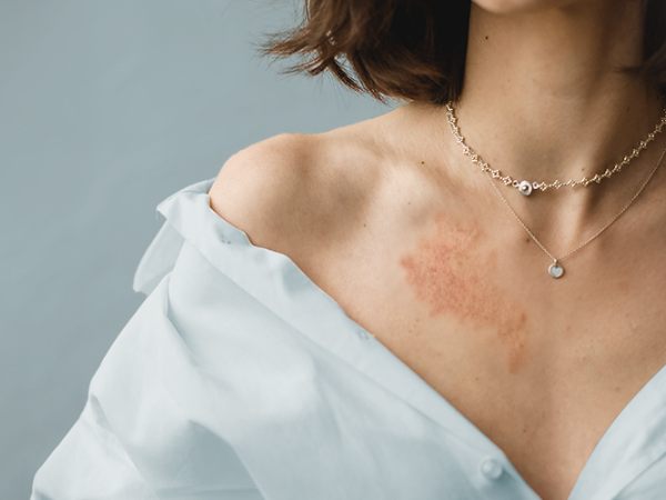 Da dễ nổi mẩn do dị ứng khi tiếp xúc với kim loại