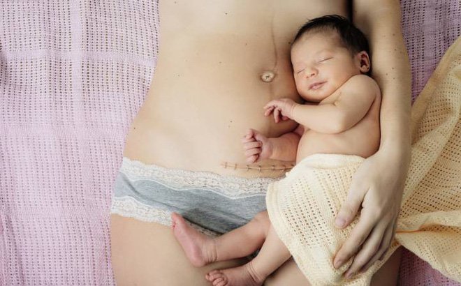 Người mẹ sau sinh nằm cạnh em bé sơ sinh trên giường, có thể thấy vết mổ ở bụng