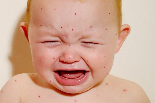 cách xử lí khi trẻ bị dị ứng