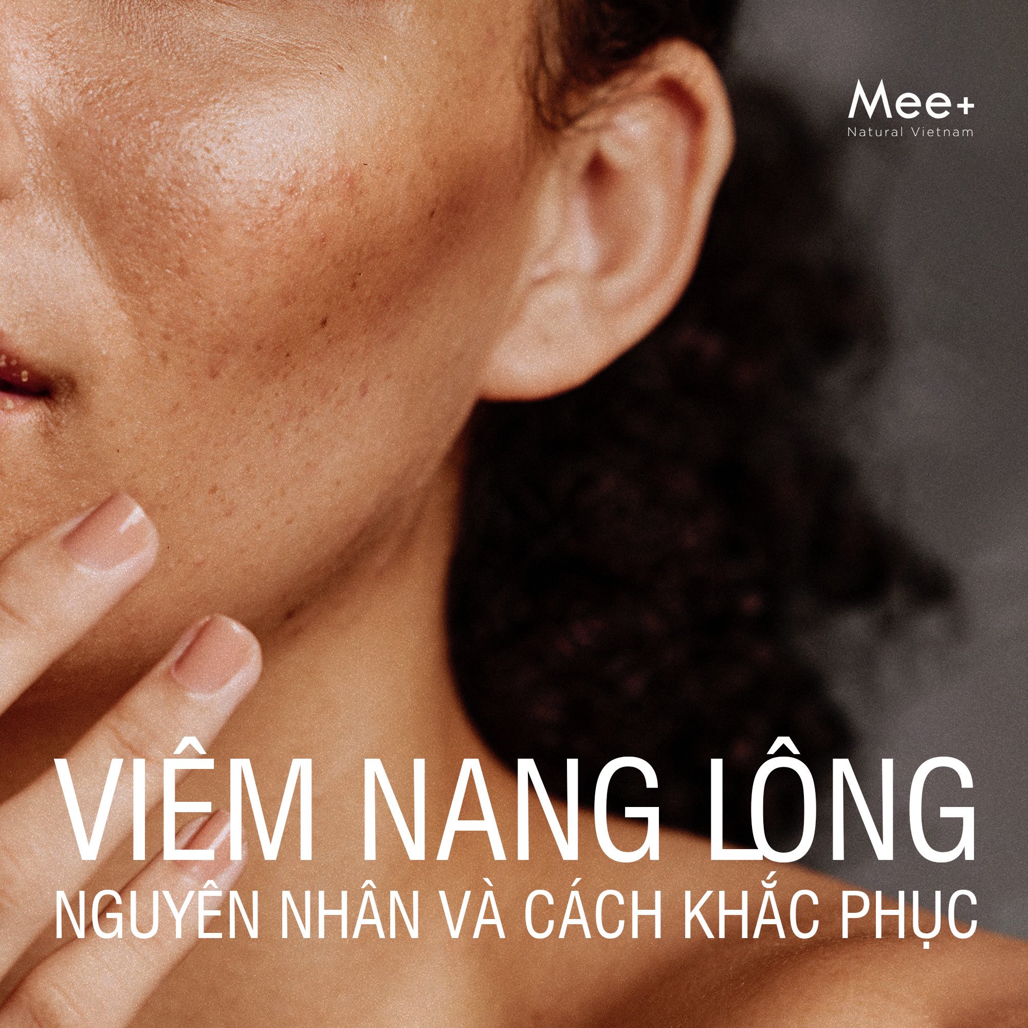 Viêm nang lông - Nguyên nhân và cách khắc phục