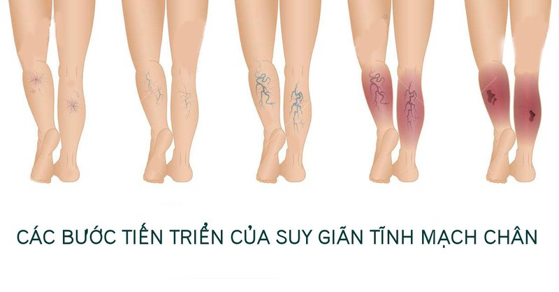 SUY TĨNH MẠCH MẠN TÍNH CHI DƯỚI LÀ BỆNH GÌ? CÓ BAO NHIÊU CÁCH ĐIỀU TRỊ CHO PHÙ HỢP VỚI BẠN?