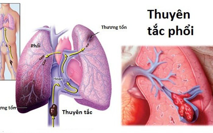 NGUYÊN NHÂN VÀ BIỂU HIỆN BỆNH THUYÊN TẮC PHỔI.