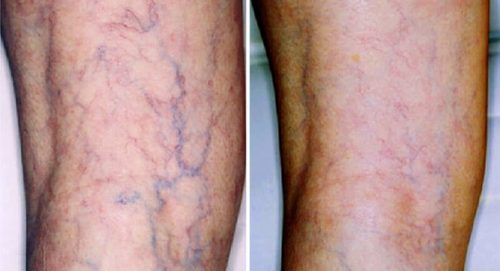 SƠ LƯỢC VỀ HUYẾT KHỐI TĨNH MẠCH SÂU ( PHẦN 3)