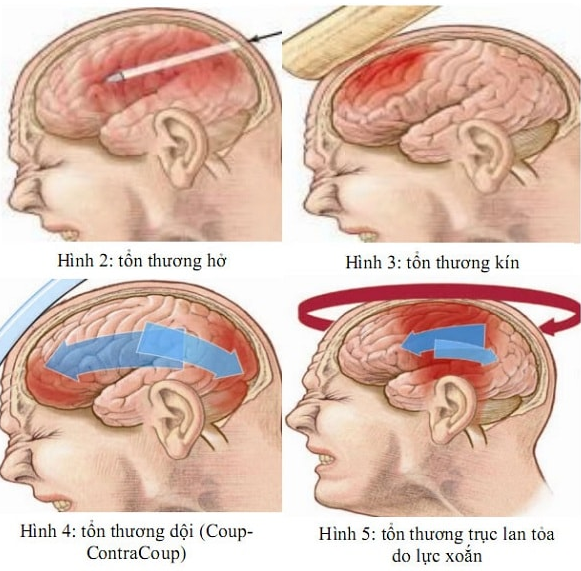 CÓ CÁC DẤU HIỆU CỦA CHẤN THƯƠNG ĐẦU KÍN SAU THÌ NÊN GẶP BÁC SĨ NGAY