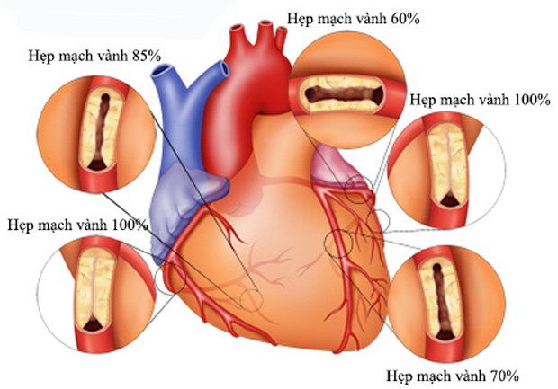 TÌM HIỂU VỀ VIỆC ĐẶT STENT ĐỘNG MẠCH VÀNH.