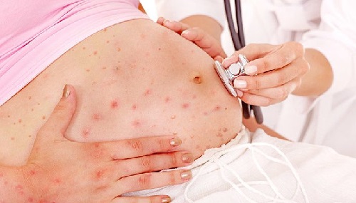 TÁC HẠI KHI KHÔNG TIÊM VẮC XIN RUBELLA DẪN ĐẾN NHIỀU DỊ TẬT.