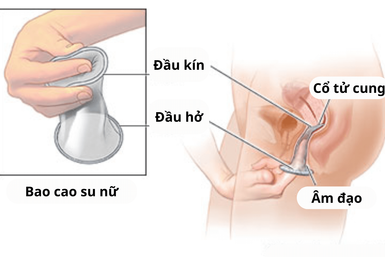 Cấu tạo và cách hoạt động của bao cao su nữ