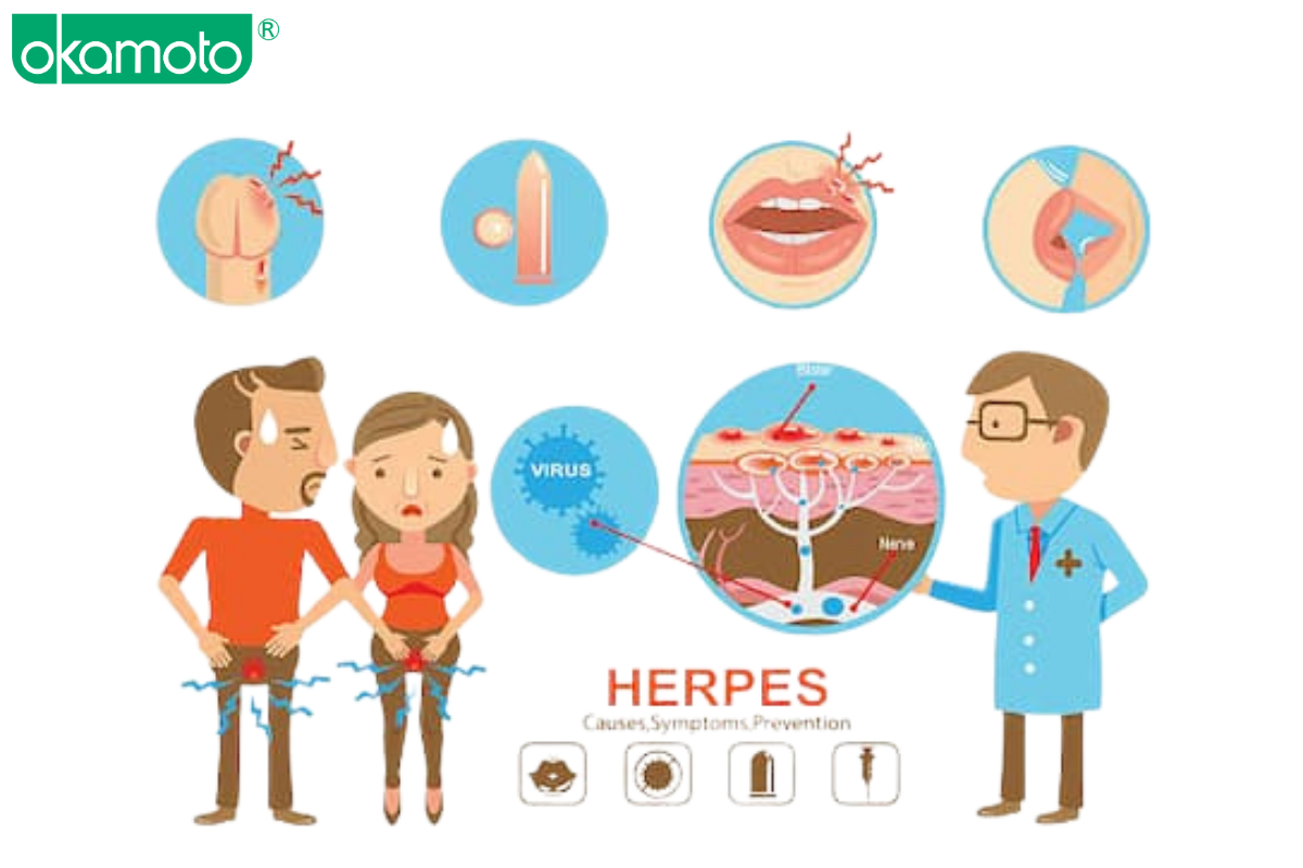 herpes sinh duc va kha nang lay lan khi quan he dong gioi