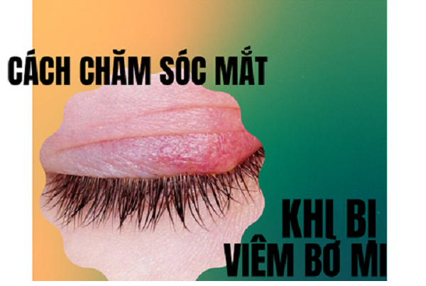 CÁCH CHĂM SÓC MẮT KHI BỊ VIÊM BỜ MI