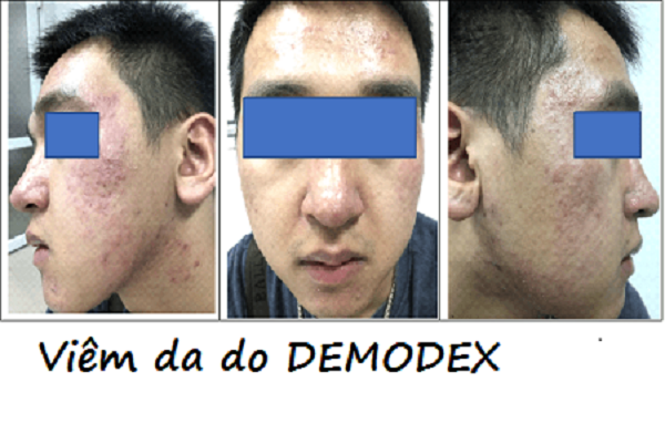 BỆNH VIÊM DA Ở NAM GIỚI DO DEMODEX