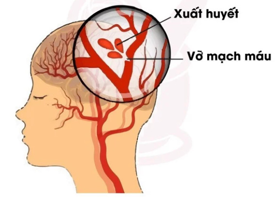 DỰ PHÒNG TAI BIẾN MẠCH MÁU NÃO