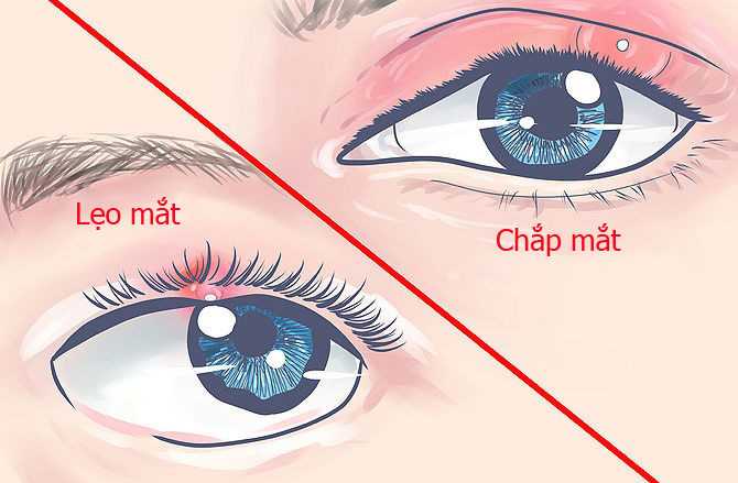 CHẮP MẮT VÀ LẸO MẮT - Bạn đã biết cách phân biệt chưa?