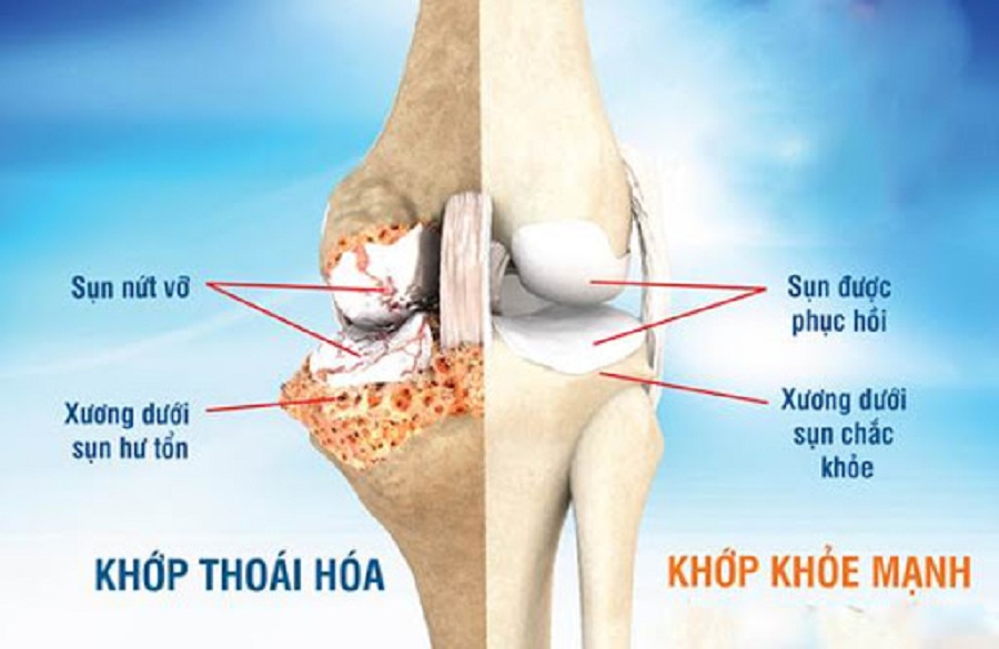 BỆNH THOÁI HÓA KHỚP