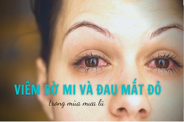 PHÒNG NGỪA VIÊM BỜ MI VÀ ĐAU MẮT ĐỎ TRONG MÙA MƯA LŨ