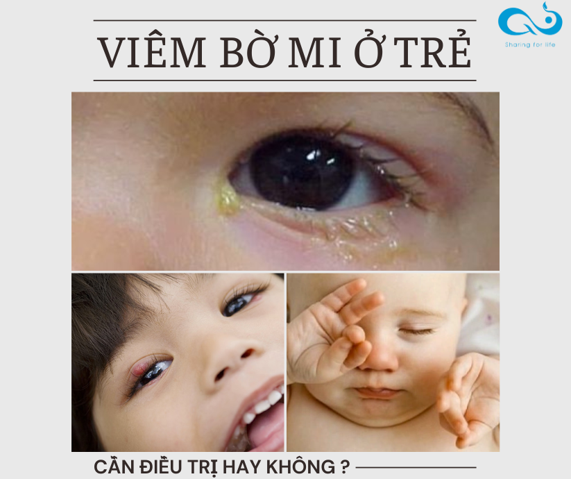 VIÊM BỜ MI Ở TRẺ - Có cần điều trị hay không?