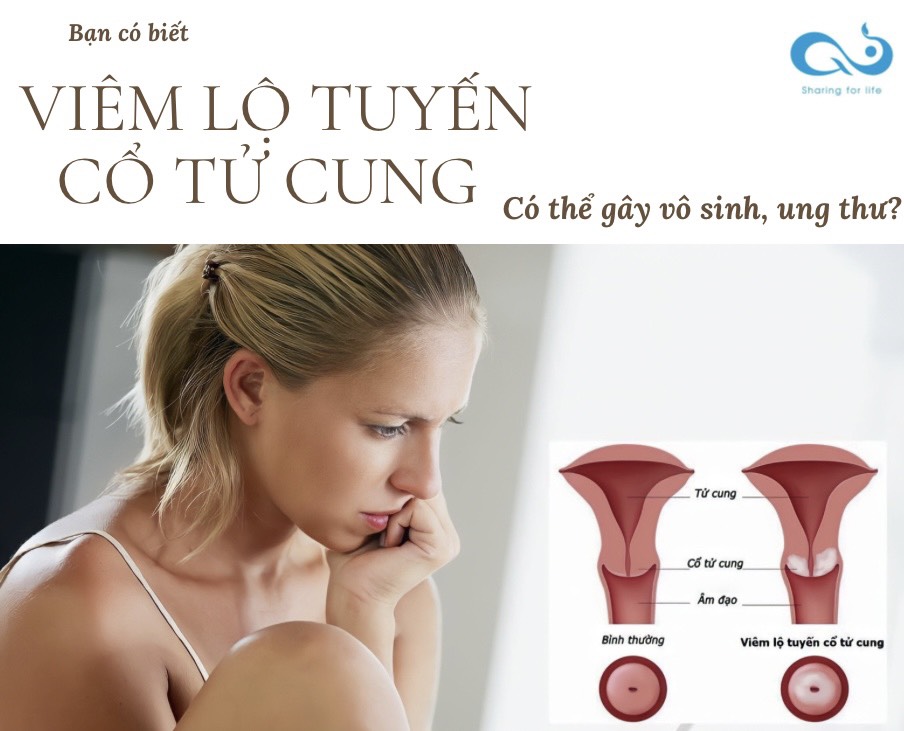 VIÊM LỘ TUYẾN CỔ TỬ CUNG CÓ THỂ GÂY VÔ SINH VÀ ÂM THẦM GÂY UNG THƯ