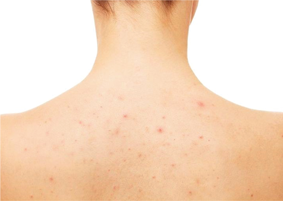 NGUYÊN NHÂN VÀ GIẢI PHÁP CHO MỤN LƯNG, MỤN NGỰC? Thế nào là mụn nang ở lưng