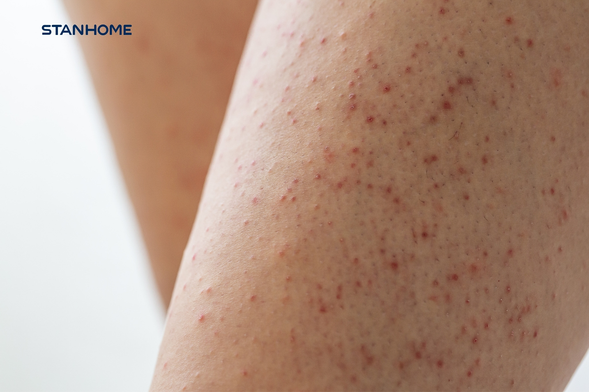 VIÊM NANG LÔNG ĐANG TĂNG NHANH TẠI VIỆT NAM | Family Expert