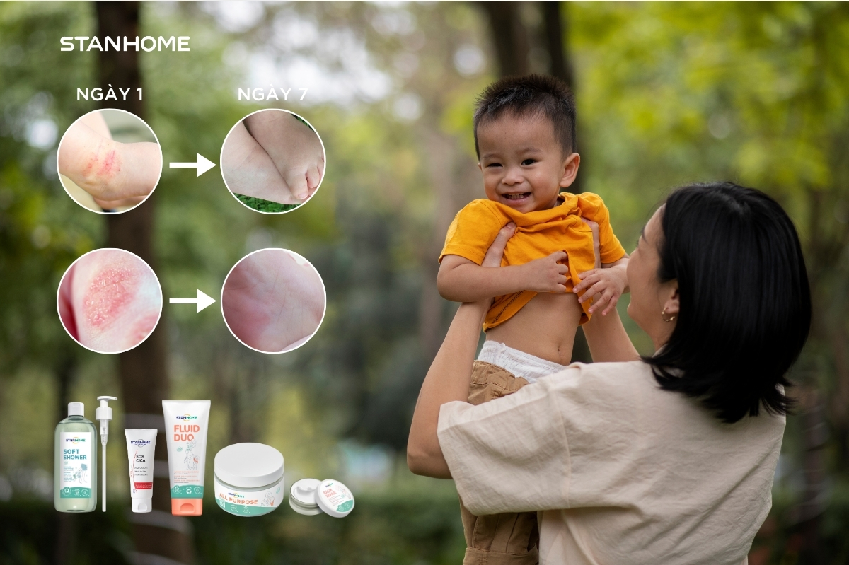 Nhờ sử dụng kem dưỡng phục hồi hàng rào bảo vệ da từ dược mỹ phẩm Stanhome đã giúp bé Bảo An phục hồi và tăng cường hàng rào bảo vệ da